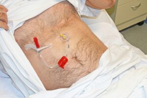 PEG Care & Feeding Pump Training (CPD Certified)