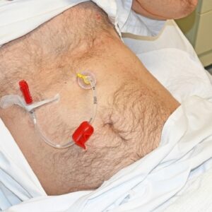 PEG Care & Feeding Pump Training (CPD Certified)